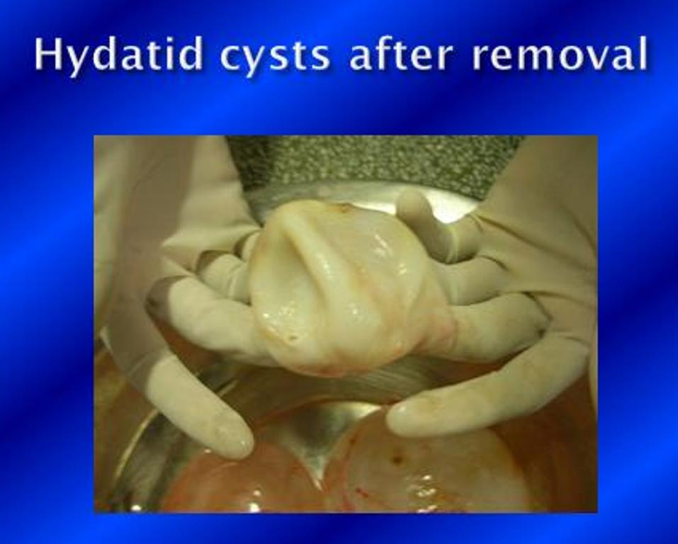 Cyst removed